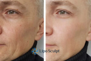 How to Fight Aging Symptoms 3 Fight Aging Symptoms West Bridgford With HIFU and Morpheus8 Today!