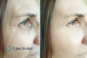 How to Fight Aging Symptoms 2 Do you want to Fight Aging Symptoms West Bridgford? Contact Lipo Sculpt today!