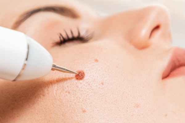 CryoPen: 5 Skin Concerns It May Be Used to Treat 3 What actually happens during a CryoPen treatment West Bridgford?