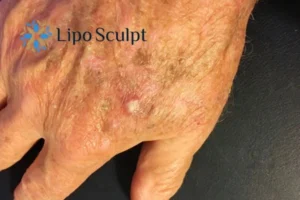 Best Actinic Keratoses Removal 2 Improve your wellbeing and health with Actinic Keratoses West Bridgford removal.treatment