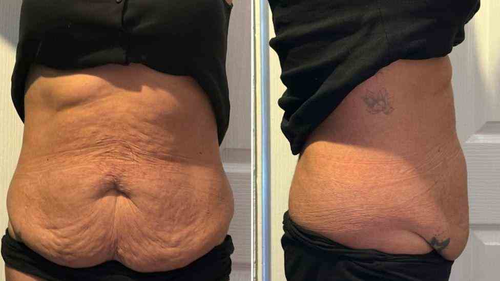 Lost the Weight but Not the Loose Skin? What You Should Know 1 Is It Definitely Loose Skin West Bridgford?